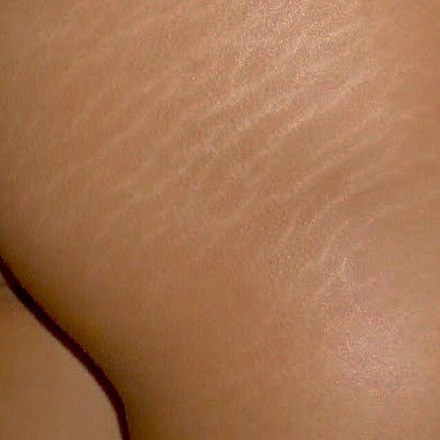 Stretch Mark Miracle Cream