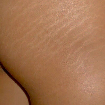 Stretch Mark Miracle Cream