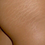 Stretch Mark Miracle Cream